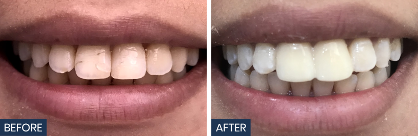 Emax veneers and teeth whitening